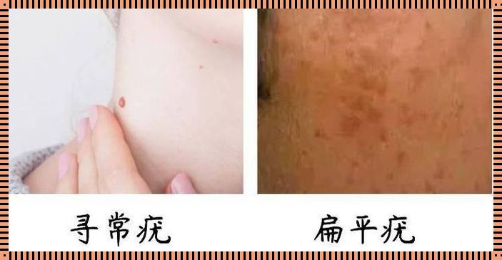 “肉粒”or“疣”：揭秘女性领域的新科技潮流