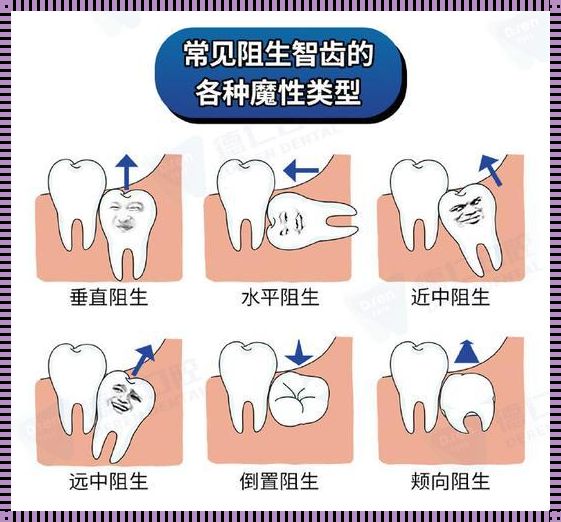 齿间杂谈：拔牙非易事，笑谈间的自嘲