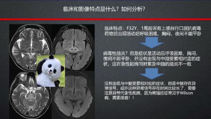 “脑干熊猫眼”：异彩纷呈的神经现象探秘