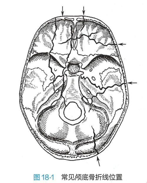 颅底骨折，轻松一“磕”