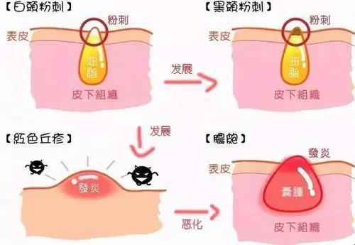 《白头粉刺，滚蛋吧！》：揭秘战“痘”高招